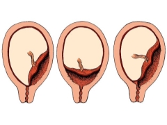 What is placenta previa and how does it affect pregnancy and childbirth?