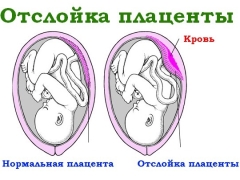 Symptoms and effects of placental abruption in late pregnancy