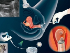 Embryo implantation in IVF. How to increase the chances of success?