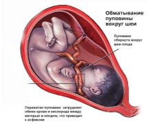 ¿Es peligroso enredar el cordón umbilical alrededor del cuello del feto y cómo afecta el parto?