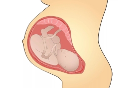 Features of the effect of a short umbilical cord on pregnancy and childbirth