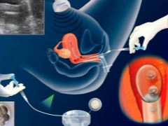 ¿Por qué no siempre es la implantación del embrión después de la FIV? Causas y sintomas