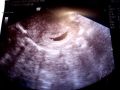 Causes and effects of deformation of the ovum