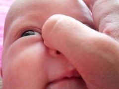 Massage of the lacrimal canal for newborns and infants