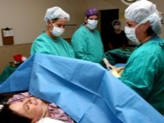 Epidural anesthesia para sa caesarean section