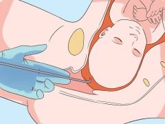 Bubble puncture for labor induction