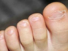 What to do if a child's toenails break or break?