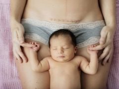 Cesarean section suture: possible problems and treatment