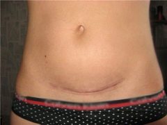 Caesarean scar