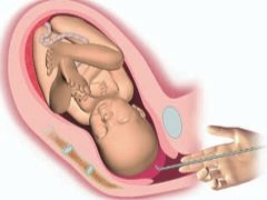 What is amniotomy in childbirth and why do the bubble puncture?