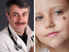 Dr. Komarovsky sobre lunares en niños.