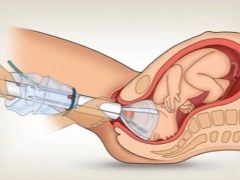 Applicazione del vuoto durante il parto