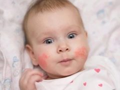 Cause psicosomatiche di eczema nei bambini e negli adulti