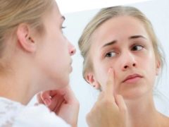 Psicosomatica dell'acne nei bambini e negli adulti