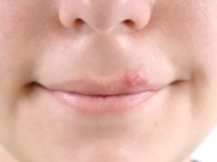 Psicosomatica dell'herpes nei bambini e negli adulti