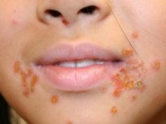 Streptoderma nei bambini: dai sintomi al trattamento