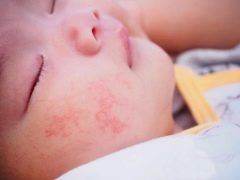 Urticaria en lactantes: de los síntomas al tratamiento.