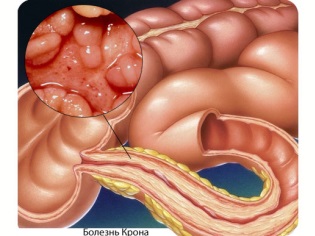 La malattia di Crohn