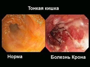 La malattia di Crohn