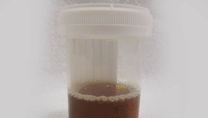 Brown urine in a child