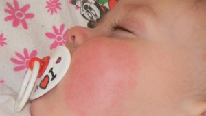 Treatment of diathesis on the cheeks in a child