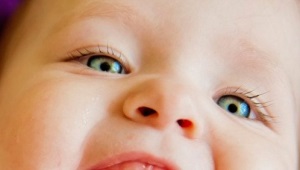 Swollen gums in infants