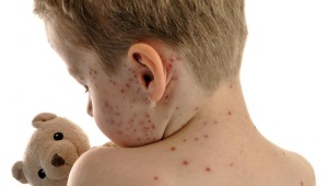 Chickenpox period inkubation