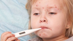 Chickenpox temperature