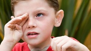 Viral conjunctivitis in children