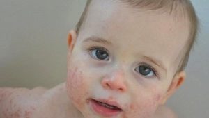 Ungüento para niños con dermatitis atópica.