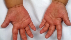 Kawasaki disease in children