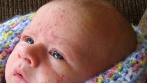 Hormonal rash in newborns and infants