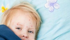 Hoe ziet een uitslag van enterovirale infecties eruit bij kinderen?