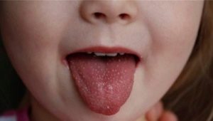 What to do if a child has a rash in the mouth?