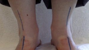 Treatment for flat-valgus foot in a child