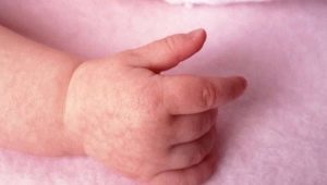 Perché un'eruzione cutanea può apparire nelle mani di un bambino e cosa fare?