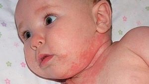 Prickly heat on baby's neck