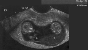 ¿Qué es la CTP fetal y cómo debería ser normal durante el embarazo?