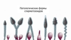 ¿Qué formas patológicas de esperma son y cómo afectan el éxito de la concepción?