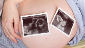 Multiple pregnancy with IVF: from likelihood to risk