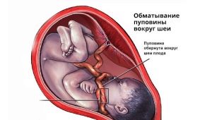 Is it dangerous to entangle the umbilical cord around the neck of the fetus and how does it affect childbirth?