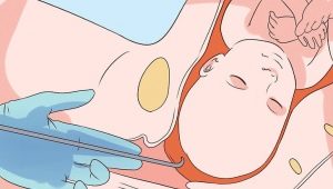 Bubble puncture for labor induction