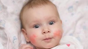 Causas psicosomáticas del eczema en niños y adultos.