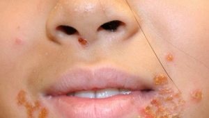 Streptoderma in children: from symptoms to treatment