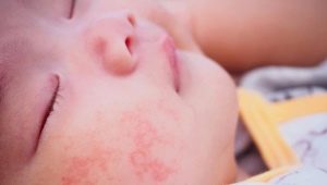 Urticaria en lactantes: de los síntomas al tratamiento.