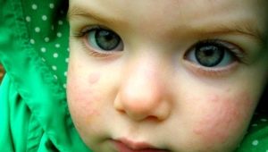 Comprender las causas de la urticaria en niños.