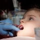 Treatment of pulpitis in milk teeth in children