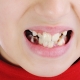 Causes of black plaque on the teeth of children