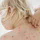 What and how can you relieve the itch of chickenpox?