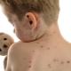 Chickenpox period inkubation